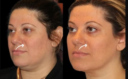Introduction to Sculptra Fillers Treatments in Dubai