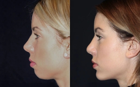 Chin Fillers Treatments in Dubai: What You Need to Know About Injections