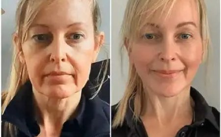 Absorb Youth with Profhilo Treatments in Dubai
