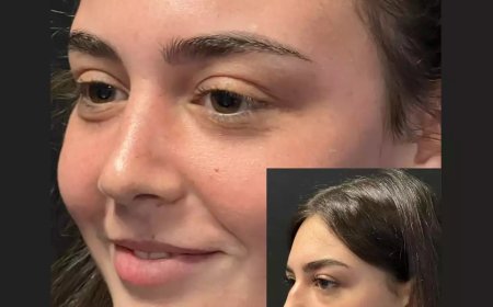 Why Patients Trust Nose Surgery in Dubai for Natural Results