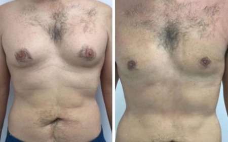 The Truth About Male Boob Reduction and Gynecomastia Surgery in Dubai