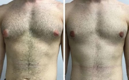 Gynecomastia Surgery in Dubai: Recovery Time and Aftercare Tips