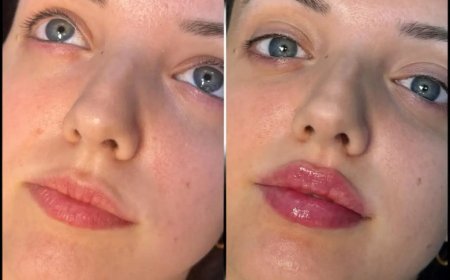 What Are the Different Types of Fillers Treatments in Dubai?