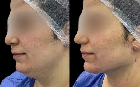 Chin Fillers Treatments in Dubai: What to Know About Post-Treatment Care