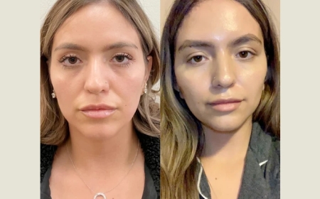 Thread Lift Treatments in Dubai: Understanding the Different Types of Threads Used