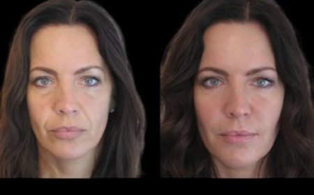 Jawline Fillers Treatments in Dubai: A Complete Look at Benefits and Results