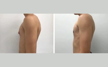 How to Choose the Best Gynecomastia Surgery in Dubai