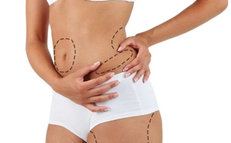 Cost of Fat Transfer Surgery in Dubai: What You Need to Know