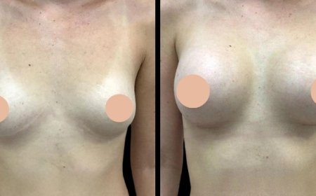 Best Breast Augmentation Surgeon in Dubai: What to Know Before Surgery