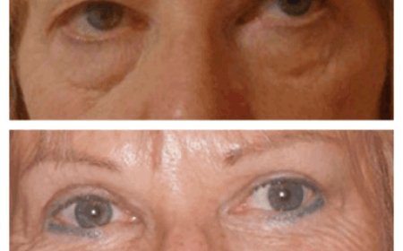 Why Eye Bag Removal Surgery in Dubai Is Becoming More Popular: Expert Insights from the Best Surgeons