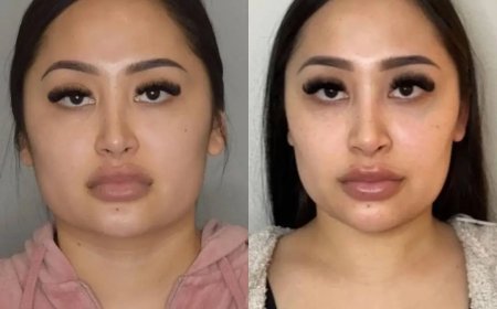 Buccal fat removal Surgery in Dubai vs. Traditional Cheek Surgery