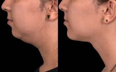 Everything You Need to Know About Double Chin Removal Surgery in Dubai