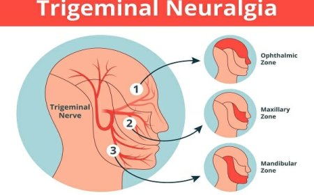 Top 10 Trigeminal Neuralgia Treatments That Actually Work