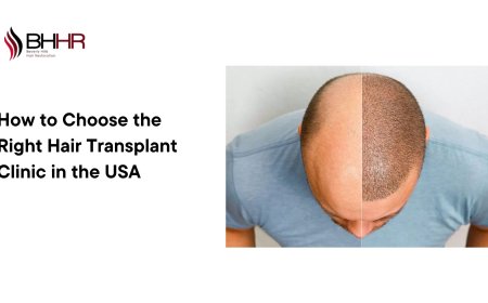 How to Choose the Right Hair Transplant Clinic in the USA