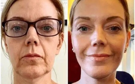 Uncover Radiance with Profhilo by Best Plastic Surgeons in dubai