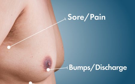 Where to Treat Gynecomastia in Islamabad: Best Clinics and Doctors