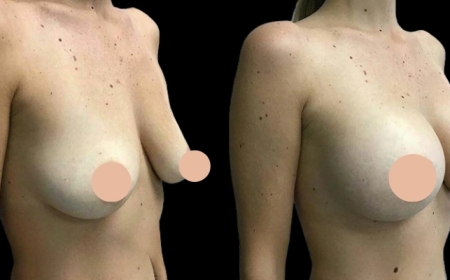 Trends in Breast Augmentation in Dubai You Should Know