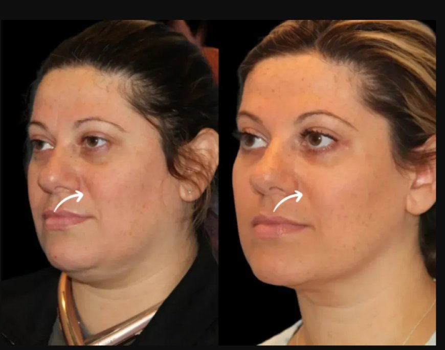 Introduction to Sculptra Fillers Treatments in Dubai
