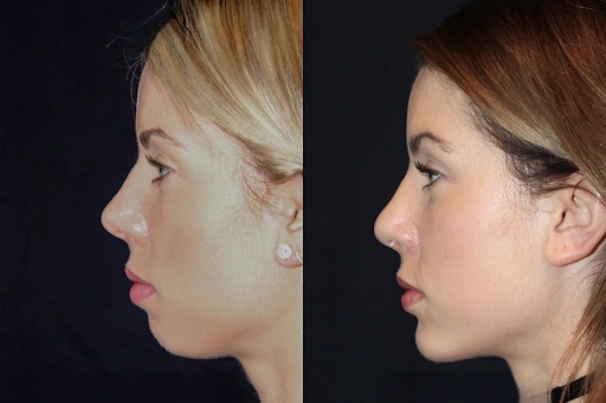 Chin Fillers Treatments in Dubai: What You Need to Know About Injections