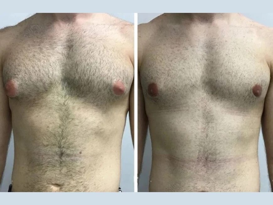 Gynecomastia Surgery in Dubai: Recovery Time and Aftercare Tips