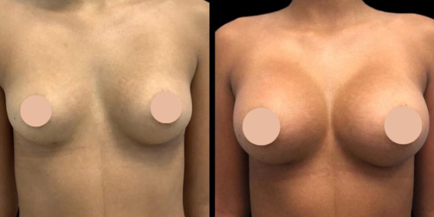 Breast Augmentation Surgery in Dubai: Cost Breakdown