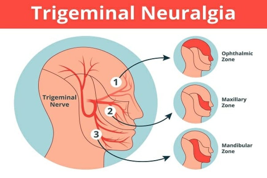 Top 10 Trigeminal Neuralgia Treatments That Actually Work