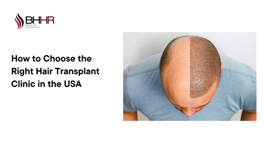 How to Choose the Right Hair Transplant Clinic in the USA