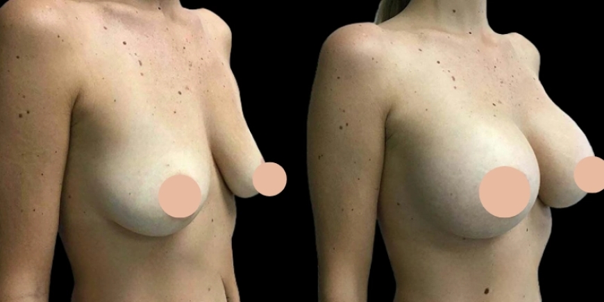 Trends in Breast Augmentation in Dubai You Should Know