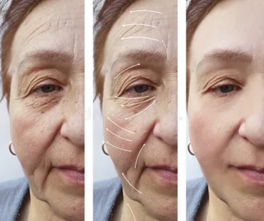 Minimalinvasive Methoden zur Behandlung von Gesichtsfalten