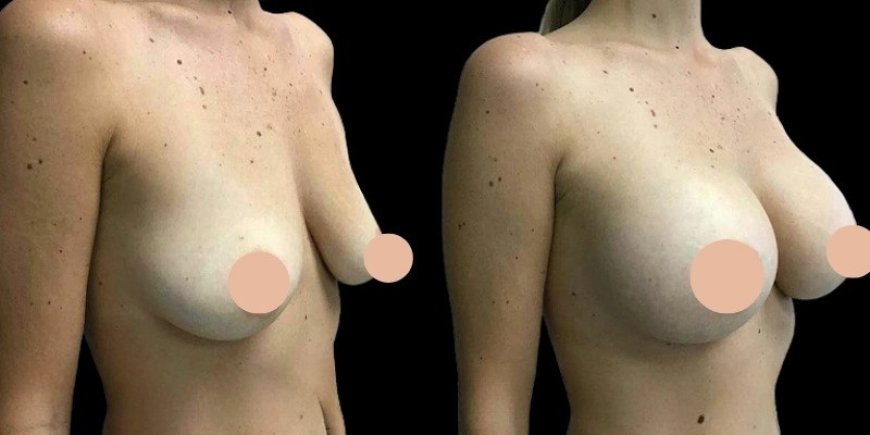 What Makes the Best Doctors in Dubai Trusted for Breast Augmentation Procedures