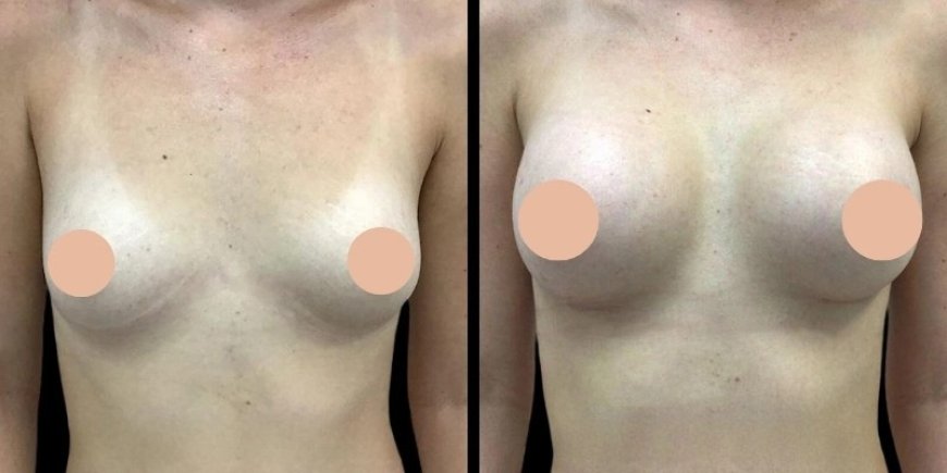 What Are the Recovery Milestones After Breast Augmentation Surgery in Dubai
