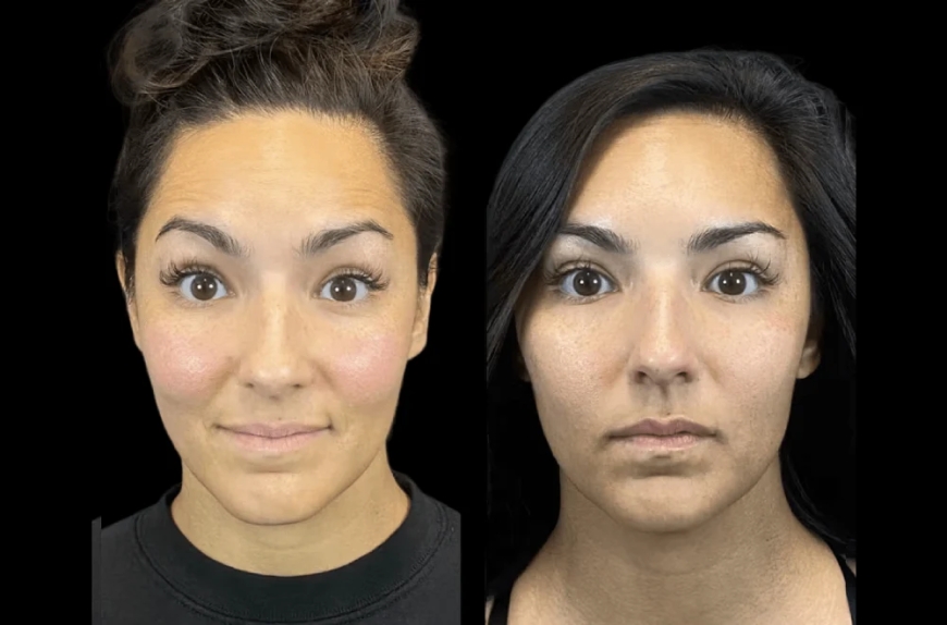 What to Expect from Your First Botox Treatment at the Best Aesthetic Clinic in dubai